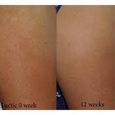 Understanding and Treating Keratosis Pilaris 5 keratosis pilaris treatment
