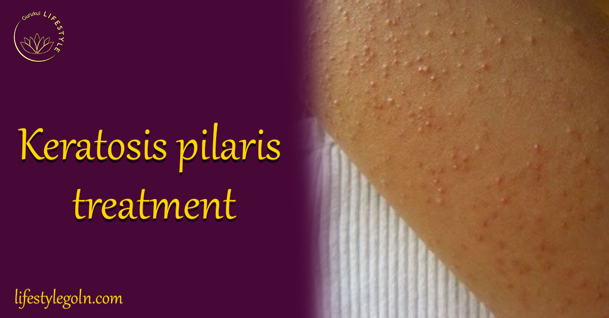 Understanding and Treating Keratosis Pilaris 1 Keratosis pilaris treatment