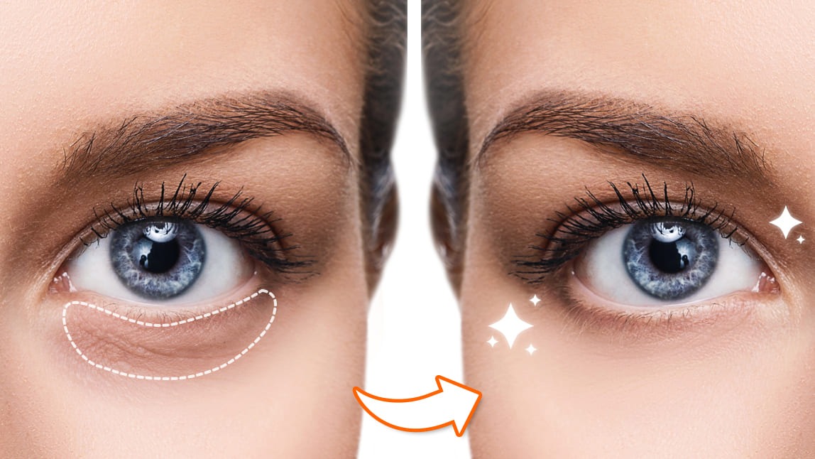 How To Remove Dark Spots On Eyes How To Remove Dark Spots On Eyes | Beautification Tips and Tricks